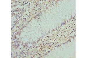 Immunohistochemistry of paraffin-embedded human colon cancer using ABIN7148460 at dilution of 1:100 (COG5 anticorps  (AA 1-260))