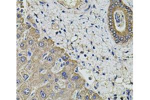 Immunohistochemistry of paraffin-embedded Human liver damage using KCNK9 Polyclonal Antibody at dilution of 1:100 (40x lens). (KCNK9 anticorps)