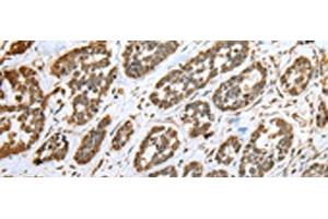 Immunohistochemistry of paraffin-embedded Human esophagus cancer tissue using CNPY2 Polyclonal Antibody at dilution of 1:25(x200) (CNPY2/MSAP anticorps)