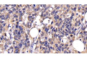 Detection of CASP10 in Human Lymphoma Tissue using Polyclonal Antibody to Caspase 10 (CASP10)