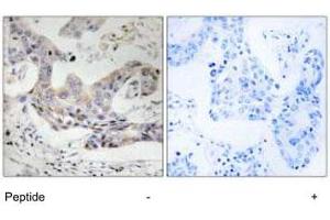 Immunohistochemistry analysis of paraffin-embedded human breast carcinoma tissue, using ALDH3B1 polyclonal antibody .