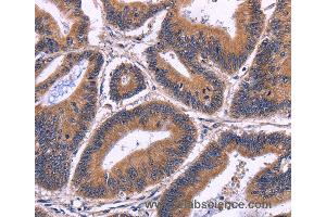 Immunohistochemistry of Human cervical cancer using SPATA7 Polyclonal Antibody at dilution of 1:30 (SPATA7 anticorps)