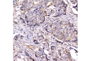 IHC testing of FFPE human breast cancer tissue with Dynamin 1 antibody at 1ug/ml. (Dynamin 1 anticorps)