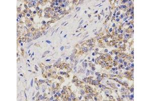 Immunohistochemistry of paraffin-embedded Human lung cancer using TNFRSF1B Polyclonal Antibody at dilution of 1:200 (40x lens). (TNFRSF1B anticorps)