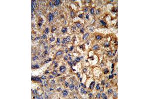 Formalin-fixed and paraffin-embedded human hepatocarcinoma reacted with HSD17B12 Antibody , which was peroxidase-conjugated to the secondary antibody, followed by DAB staining. (HSD17B12 anticorps  (AA 126-155))
