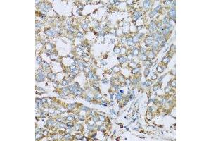 Immunohistochemistry of paraffin-embedded human liver cancer using COX6A1 antibody. (COX6A1 anticorps  (AA 25-109))