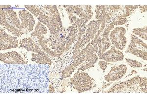 Immunohistochemical analysis of paraffin-embedded human liver cancer tissue. (IL-8 anticorps  (C-Term))