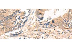 Immunohistochemistry of paraffin-embedded Human colorectal cancer tissue using ABHD2 Polyclonal Antibody at dilution of 1:40(x200) (ABHD2 anticorps)