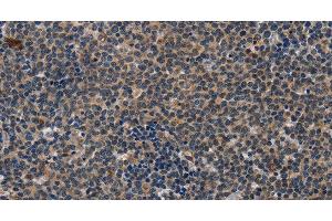 Immunohistochemistry of paraffin-embedded Human lymphoma tissue using CD47 Polyclonal Antibody at dilution 1:50 (CD47 anticorps)