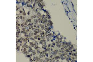 Immunohistochemistry of paraffin-embedded human lung cancer using TEAD1 antibody (ABIN6291475) at dilution of 1:100 (40x lens).