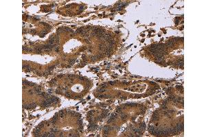 Immunohistochemistry of Human colon cancer using EDN2 Polyclonal Antibody at dilution of 1:30 (Endothelin 2 anticorps)