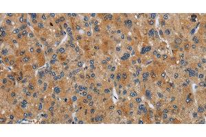 Immunohistochemistry of paraffin-embedded Human liver cancer tissue using FLCN Polyclonal Antibody at dilution 1:40 (FLCN anticorps)