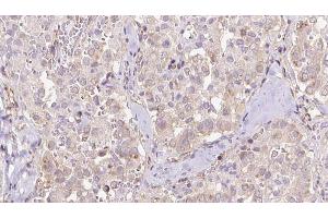 ABIN6273316 at 1/100 staining Human thyroid cancer tissue by IHC-P. (Seladin 1 anticorps  (N-Term))