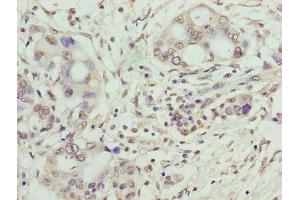 Immunohistochemistry of paraffin-embedded human pancreatic cancer using ABIN7171128 at dilution of 1:100