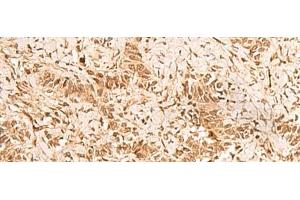 Immunohistochemistry of paraffin-embedded Human ovarian cancer tissue using HOXC12 Polyclonal Antibody at dilution of 1:50(x200) (HOXC12 anticorps)