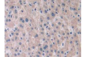 DAB staining on IHC-P; Samples: Human Liver cancer Tissue