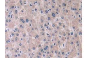 DAB staining on IHC-P; Samples: Human Liver cancer Tissue (PAFAH2 anticorps  (AA 1-392))