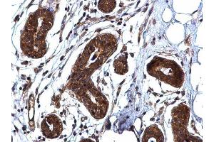 IHC-P Image ROCK1 antibody [N1N2], N-term detects ROCK1 protein at cytoplasm on human breast carcinoma by immunohistochemical analysis. (ROCK1 anticorps  (N-Term))