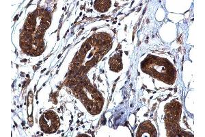 IHC-P Image ROCK1 antibody [N1N2], N-term detects ROCK1 protein at cytoplasm on human breast carcinoma by immunohistochemical analysis.
