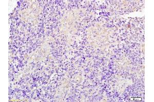 Formalin-fixed and paraffin embedded human glioma tissue labeled with Anti-JUP/Cateninma γ Polyclonal Antibody, Unconjugated at 1:200 followed by conjugation to the secondary antibody and DAB staining