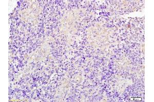 Formalin-fixed and paraffin embedded human glioma tissue labeled with Anti-JUP/Cateninma γ Polyclonal Antibody, Unconjugated at 1:200 followed by conjugation to the secondary antibody and DAB staining (JUP anticorps  (AA 601-700))