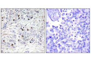 Immunohistochemistry analysis of paraffin-embedded human breast carcinoma tissue, using TEAD2 antibody. (TEAD2 anticorps  (Internal Region))