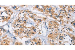Immunohistochemistry of paraffin-embedded Human thyroid cancer using Cathepsin L Polyclonal Antibody at dilution of 1:40 (Cathepsin L anticorps)