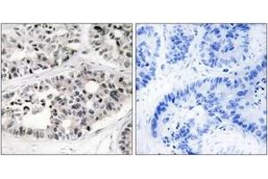Immunohistochemistry analysis of paraffin-embedded human lung carcinoma tissue, using Collagen VII alpha1 Antibody. (COL7A1 anticorps  (AA 1841-1890))
