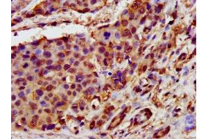 IHC image of ABIN7154521 diluted at 1:400 and staining in paraffin-embedded human pancreatic cancer performed on a Leica BondTM system.