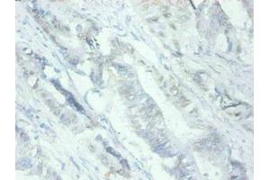 Immunohistochemical of paraffin-embedded human Colon cancer tissues using ABIN7159679 at dilution of 1:200