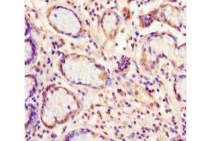 Immunohistochemistry of paraffin-embedded human gastric cancer using ABIN7152221 at dilution of 1:100 (EIF6 anticorps  (AA 1-245))