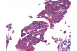 Anti-GPRC6A antibody IHC of human Ovary, Carcinoma. (GPRC6A anticorps  (N-Term))