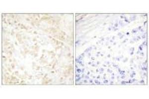 Immunohistochemistry analysis of paraffin-embedded human breast carcinoma tissue using XRCC6 antibody.