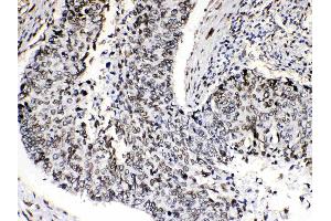 Emerin was detected in paraffin-embedded sections of human lung cancer tissues using rabbit anti- Emerin Antigen Affinity purified polyclonal antibody (Catalog # ) at 1 µg/mL.