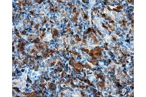 Immunohistochemical staining of paraffin-embedded Adenocarcinoma of colon tissue using anti-RC219453 mouse monoclonal antibody. (NPR3 anticorps)