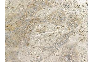 ABIN6260725 and ABIN6266688 at 1/100 staining human esophageal carcinoma by IHC-P. (CDK2AP1 anticorps  (C-Term))