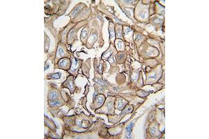 Formalin-fixed and paraffin-embedded human lung carcinoma tissue reacted with HRAS antibody , which was peroxidase-conjugated to the secondary antibody, followed by DAB staining. (HRAS anticorps  (AA 104-128))