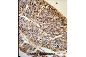 PITX1 Antibody (RB18913) IHC analysis in formalin fixed and paraffin embedded human Lung carcinoma followed by peroxidase conjugation of the secondary antibody and DAB staining.