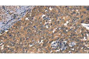 Immunohistochemistry of paraffin-embedded Human cervical cancer using DAAM1 Polyclonal Antibody at dilution of 1:50 (DAAM1 anticorps)