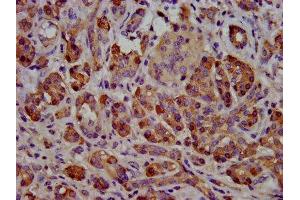 IHC image of ABIN7145595 diluted at 1:500 and staining in paraffin-embedded human pancreatic cancer performed on a Leica BondTM system. (Cholesterol Esterase anticorps  (AA 661-753))