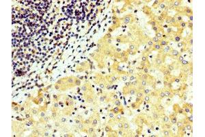 IHC image of ABIN7166300 diluted at 1:300 and staining in paraffin-embedded human liver cancer performed on a Leica BondTM system.