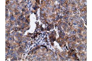 Immunohistochemical staining of paraffin-embedded Human colon tissue using anti-KHK mouse monoclonal antibody. (Ketohexokinase anticorps)