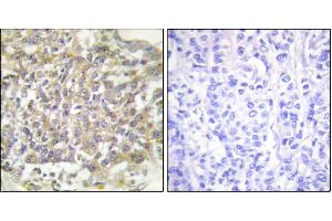 Immunohistochemical analysis of paraffin-embedded human breast carcinoma tissue using Shc (Ab-349) antibody. (SHC1 anticorps)