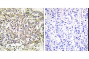 Immunohistochemical analysis of paraffin-embedded human breast carcinoma tissue using Shc (Ab-349) antibody.
