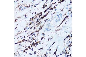 Immunohistochemistry of paraffin-embedded human breast cancer using SPN antibody. (CD43 anticorps  (AA 276-400))