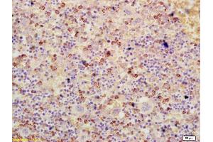 Formalin-fixed and paraffin embedded human colon cancer labeled with Anti-ATF3 Polyclonal Antibody, Unconjugated (ABIN669561) at 1:200 followed by conjugation to the secondary antibody and DAB staining (ATF3 anticorps  (AA 51-150))