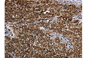 The image on the left is immunohistochemistry of paraffin-embedded Human cervical cancer tissue using ABIN7191991(PRDM2 Antibody) at dilution 1/25, on the right is treated with synthetic peptide. (PRDM2 anticorps)