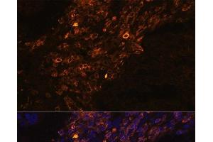Immunofluorescence analysis of Human lung cancer cells using KRT7 Polyclonal Antibody at dilution of 1:100. (Cytokeratin 7 anticorps)