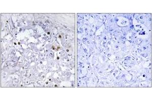 Immunohistochemistry analysis of paraffin-embedded human liver carcinoma, using HNF4 alpha (Phospho-Ser313) Antibody.