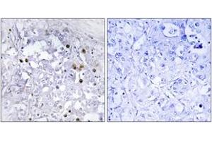 Immunohistochemistry analysis of paraffin-embedded human liver carcinoma, using HNF4 alpha (Phospho-Ser313) Antibody. (HNF4A anticorps  (pSer313))